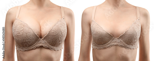 Woman before and after breast size correction on white background. Plastic surgery concept photo