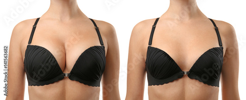 Obraz na plátne Woman before and after breast size correction on white background