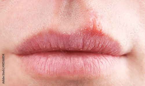 Herpes blisters on female lips closeup