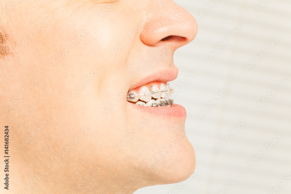 Braces for orthodontic treatment of man's bite Braces for orthodontic treatment of man's bite