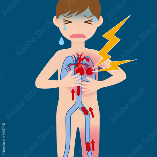 Economy class syndrome mechanism, deep vein thrombosis(DVT), coronary thrombosis, illustration diagram