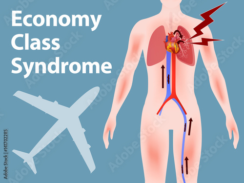 Economy class syndrome mechanism, deep vein thrombosis(DVT), Pulmonary Embolism(PE), coronary thrombosis, illustration diagram