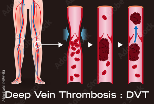 Economy class syndrome mechanism, deep vein thrombosis(DVT), Pulmonary Embolism(PE), coronary thrombosis, illustration diagram