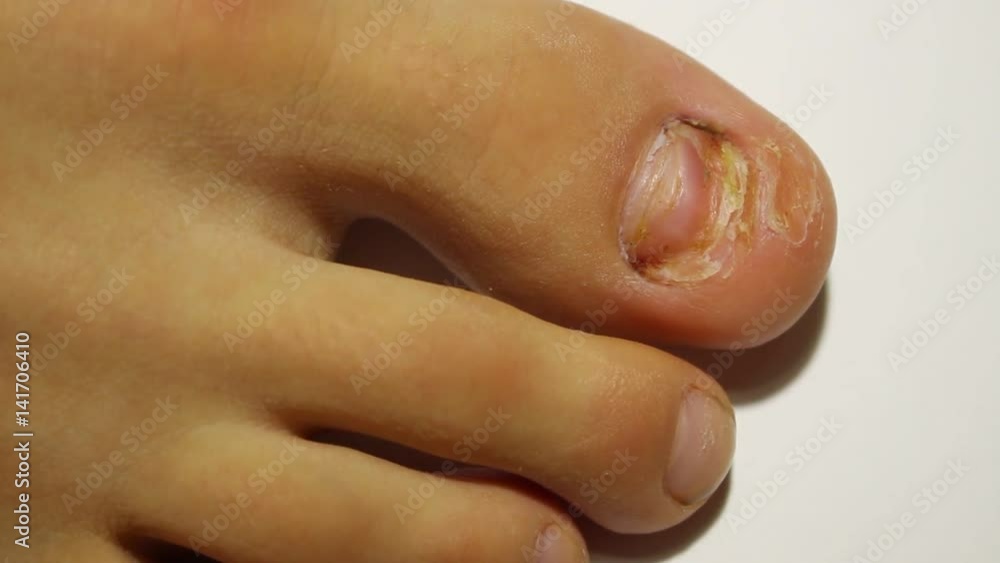 A new nail grow back in its place. Nail was surgically removed, a new nail grows in its place A new nail grow back in its place. Nail was surgically removed, a new nail grows in its place