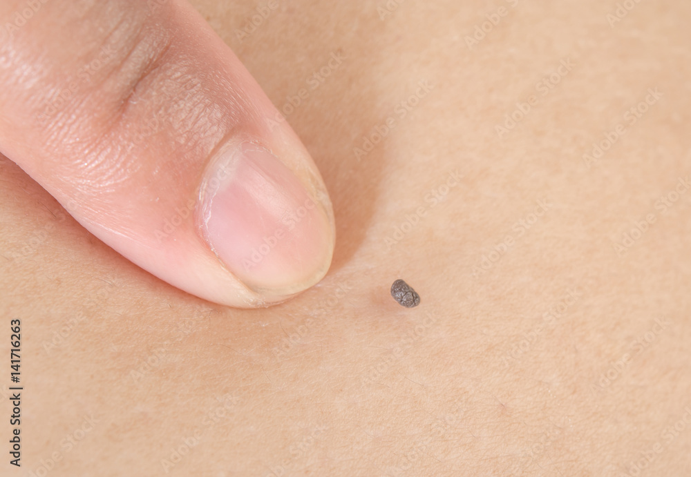 A lump on the skin A lump on the skin