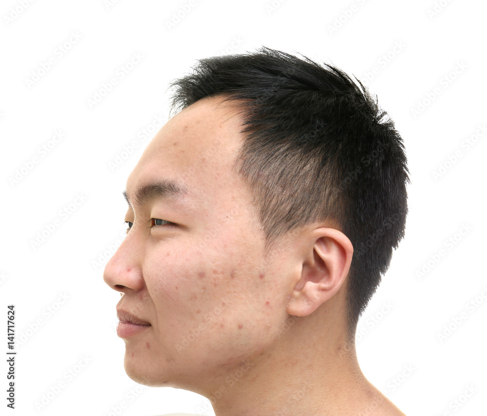 Fototapeta premium Young Asian man with problem skin on white background