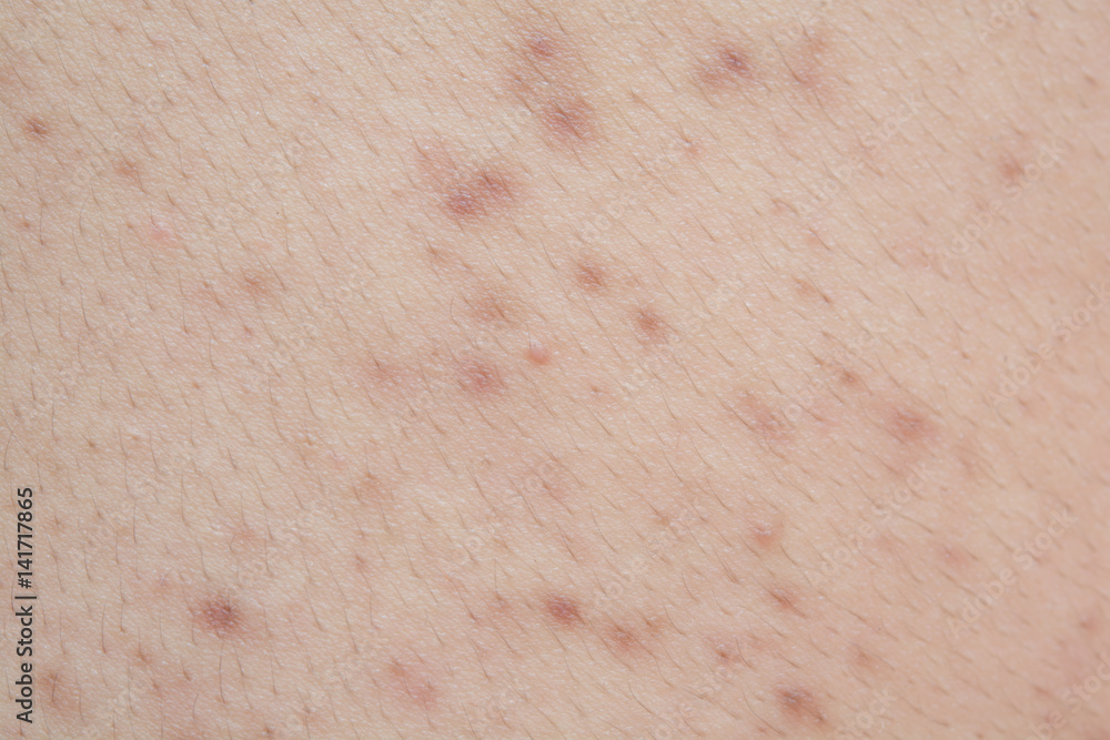 Acne on the back Acne on the back