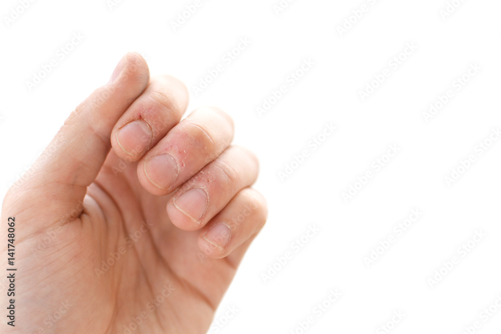 Bitten fingers close-up on a white background. Terribly badly bitten fingers of a hand. Stress. Nervousness. Habit. Depression. Till blood. Mutilated. Isolate Bitten fingers close-up on a white background. Terribly badly bitten fingers of a hand. Stress. Nervousness. Habit. Depression. Till blood. Mutilated. Isolate