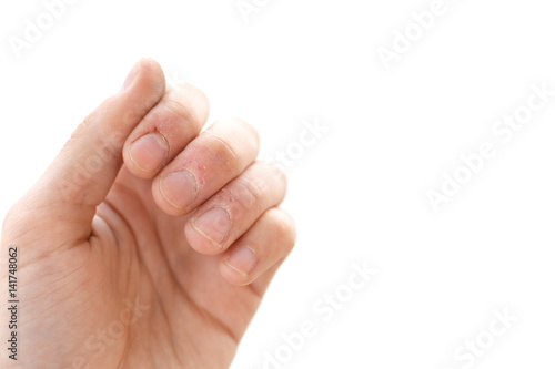 Bitten fingers close-up on a white background. Terribly badly bitten fingers of a hand. Stress. Nervousness. Habit. Depression. Till blood. Mutilated. Isolate © nagornyisergiy