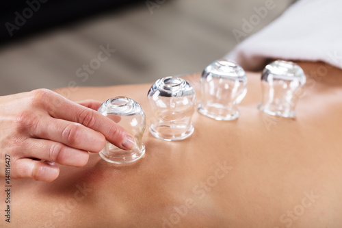 Therapist Placing Cups On Person's Back photo