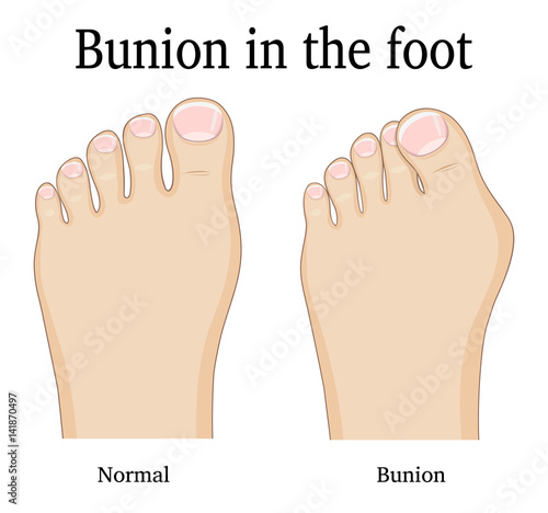 Bunion in the foot