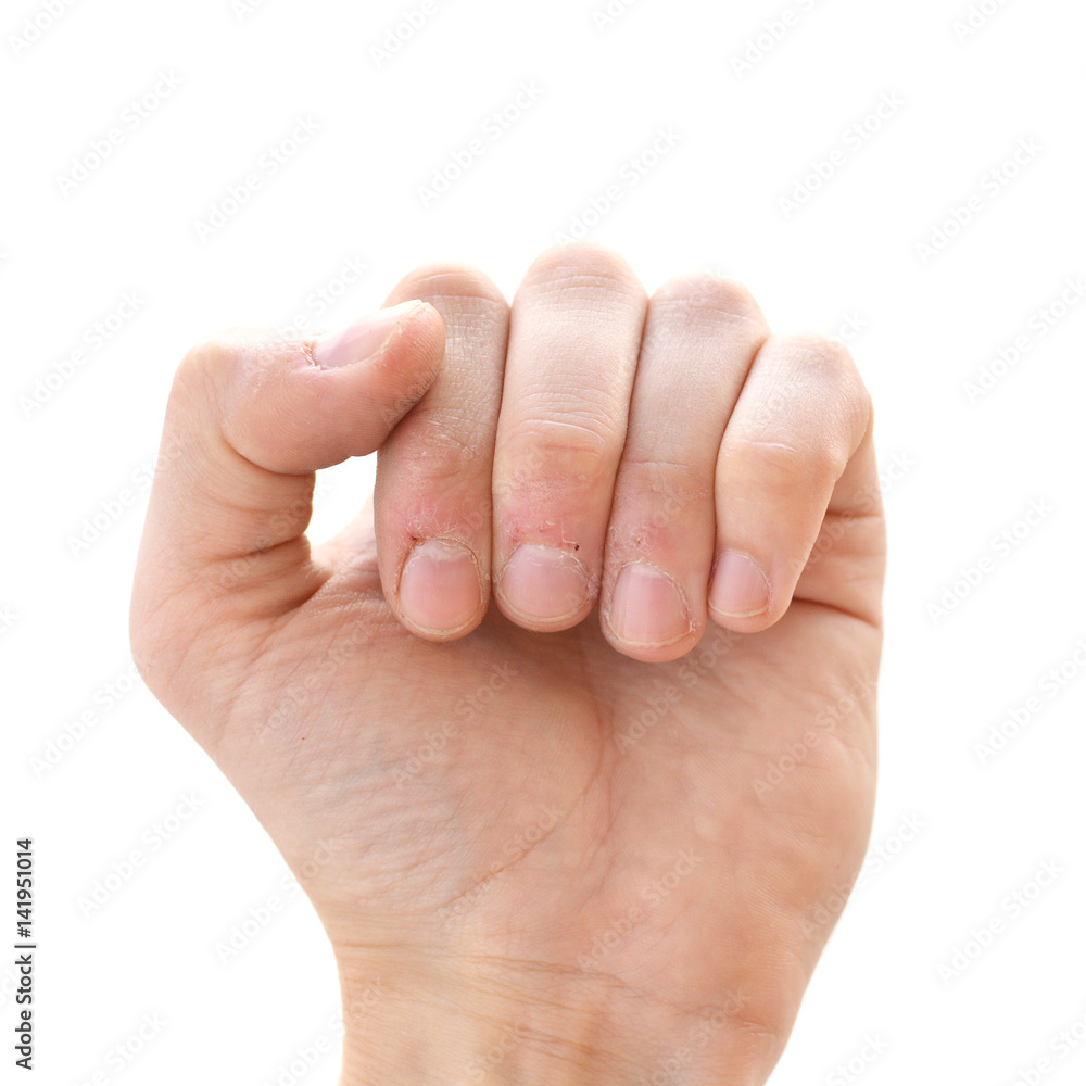 Bitten fingers close-up on a white background. Terribly badly bitten fingers of a hand. Stress. Nervousness. Habit. Depression. Till blood. Mutilated. Isolate Bitten fingers close-up on a white background. Terribly badly bitten fingers of a hand. Stress. Nervousness. Habit. Depression. Till blood. Mutilated. Isolate