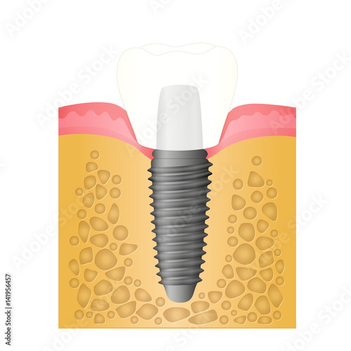 Dental implant