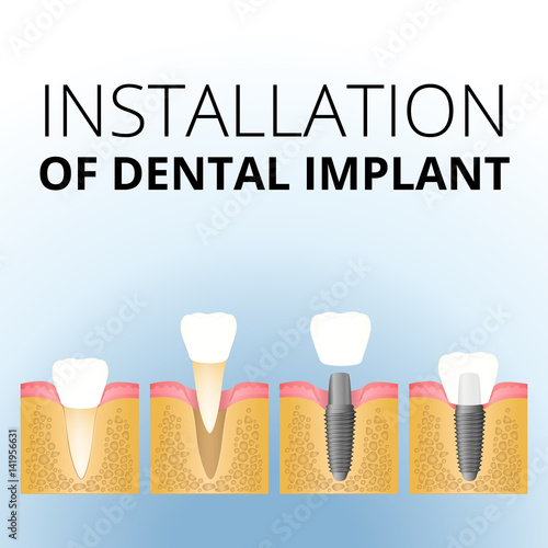 implantation of the tooth
