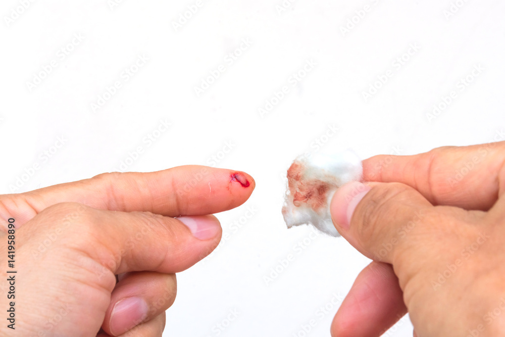 Use a cotton ball plating alcohol wipe clean wound on the index finger