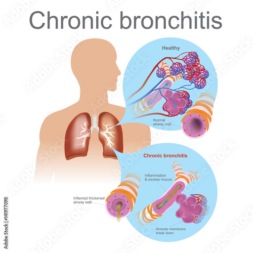 Chronic bronchitis. Acute bronchitis is usually caused by viruses, typically the same viruses that cause colds and flu. photo