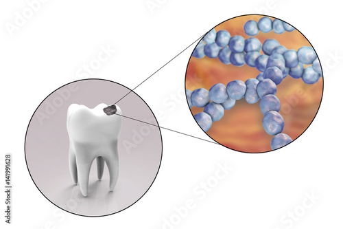 Tooth with dental caries and close-up view of microbes which cause caries Streptococcus mutans, 3D illustration photo
