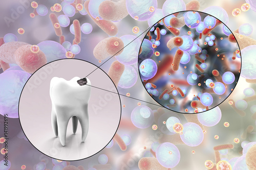 Tooth with decay, dental caries and close-up view of microbes which cause caries, 3D illustration photo