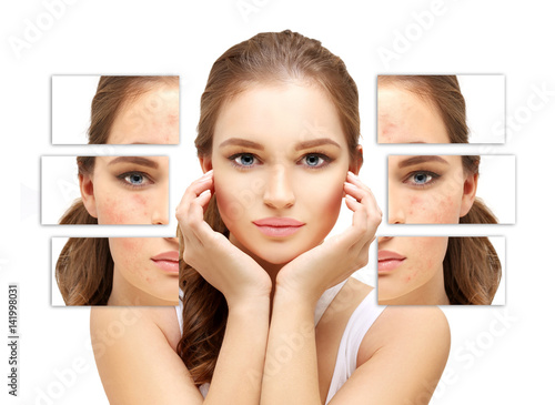 Fotografie Post-Acne Marks /Treating Acne Scars