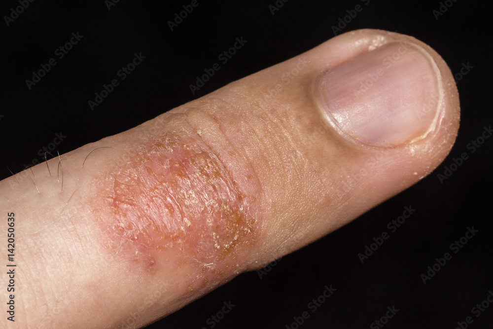 Fototapeta premium Eczema occurring on fingers.