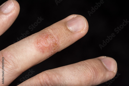Eczema occurring on fingers.