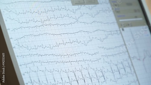 Overall nurses station monitor in the intensive care unit. ECG monitor screen.