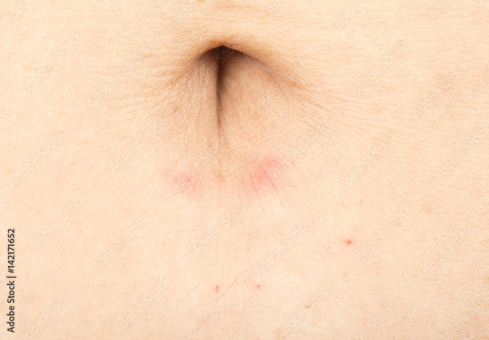 Rash in women Rash in women