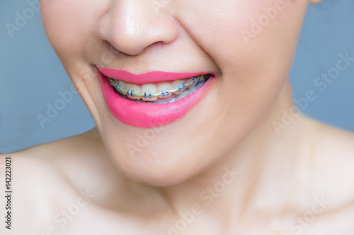 A smiling lady wearing braces on her teeth.