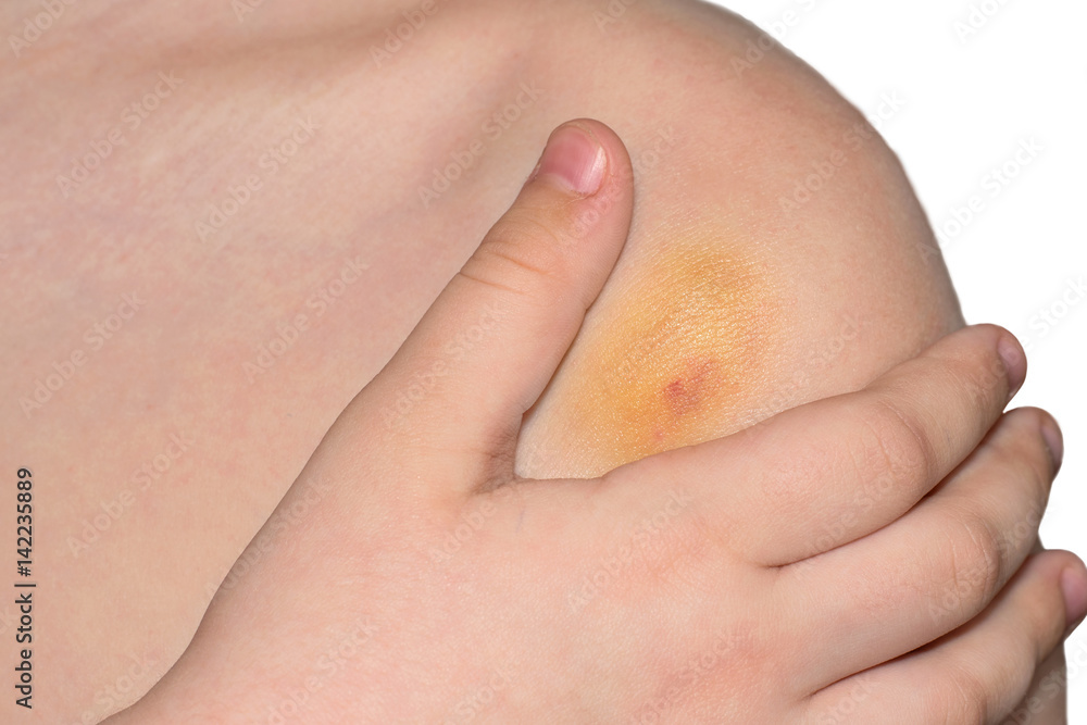 Fototapeta premium ?hild holds his hand over his shoulder on which there is a bruise.