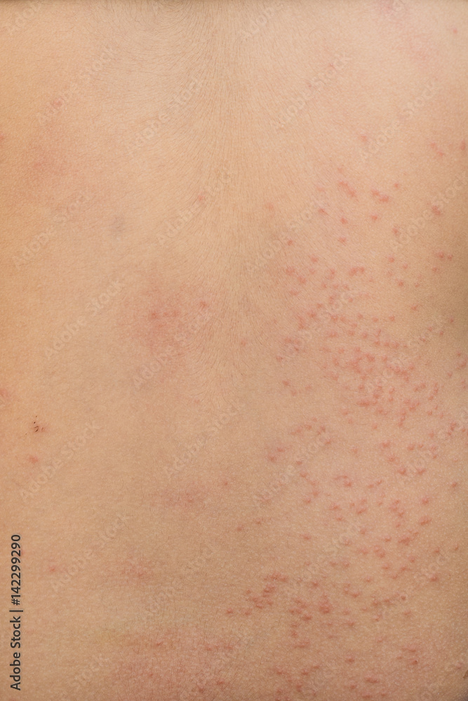 detail of rash on back from allergy detail of rash on back from allergy