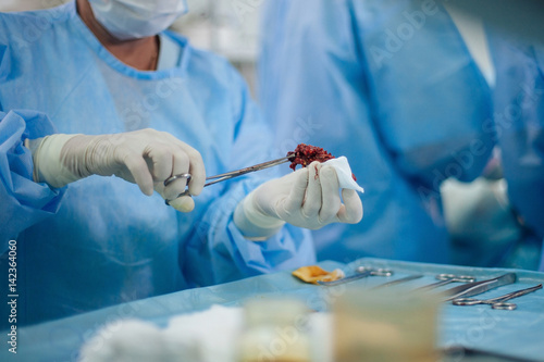 Malignant tumor removed holden by nurse in surgical clamp close-up