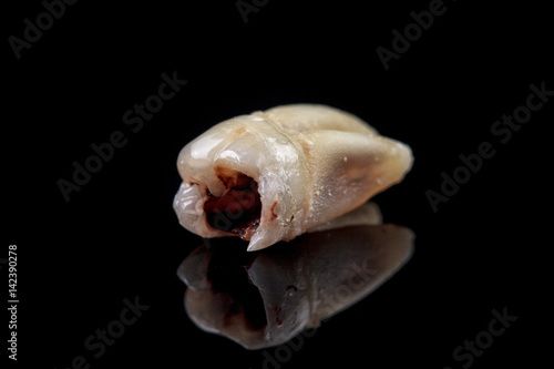 The remote tooth is damaged by caries on a black background. Macro.