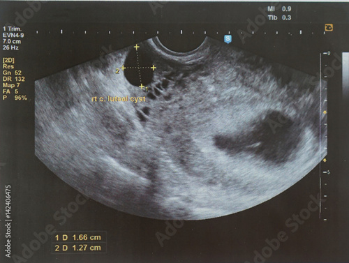 ultrasound of a fetus at 7 weeks 5 Days,sound or other vibrations having an ultrasonic frequency, particularly as used in medical imaging especially one of a pregnant woman to examine the fetus. photo