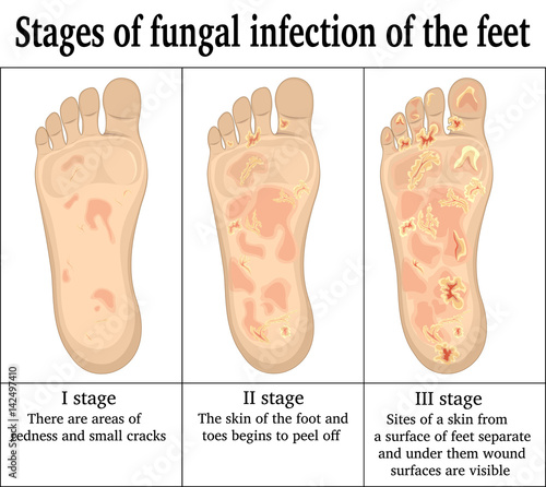 Fungal infection on the feet
