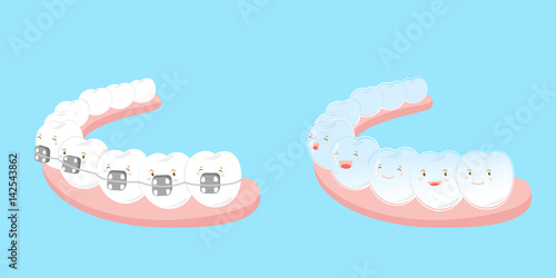 tooth wear different brace