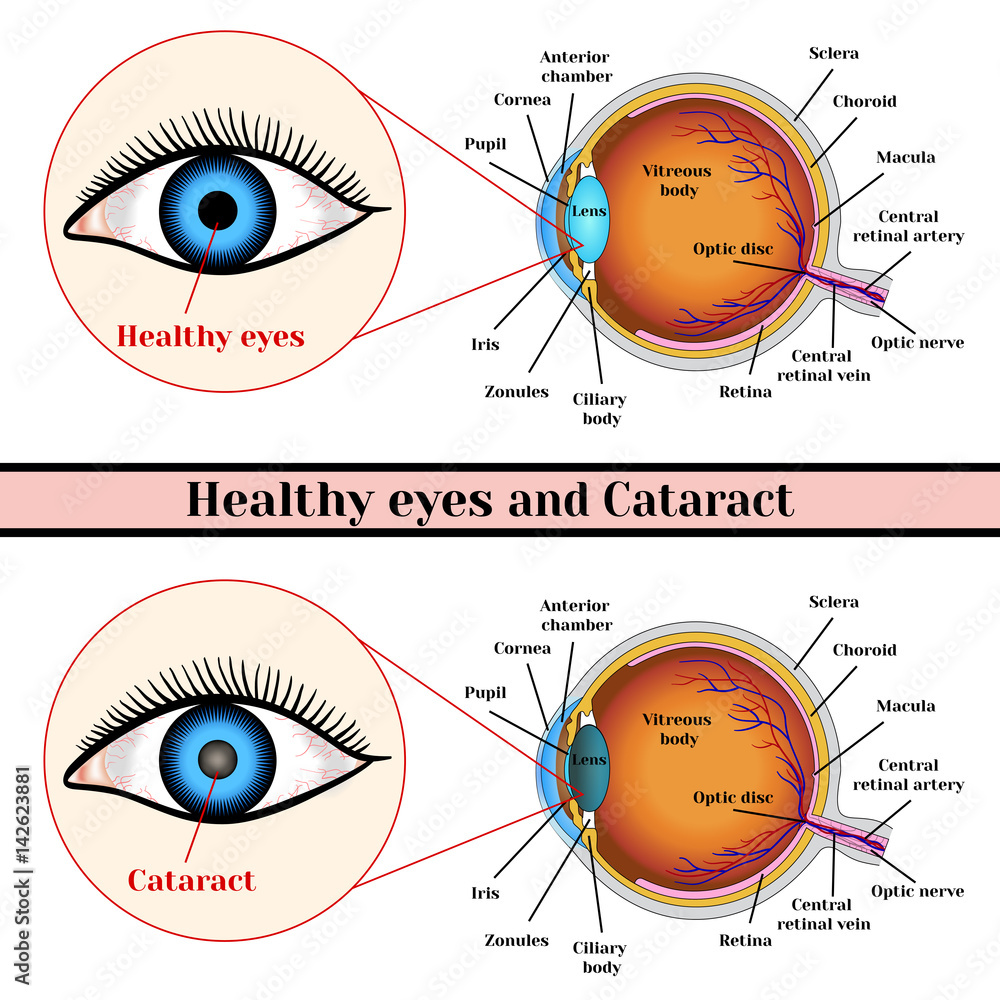 Healthy eyes and cataract (opacity of the eye lens). Stock Vector