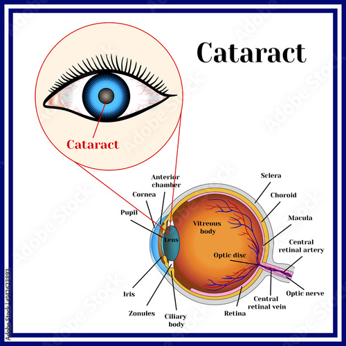 Cataract. Opacity of the eye lens.