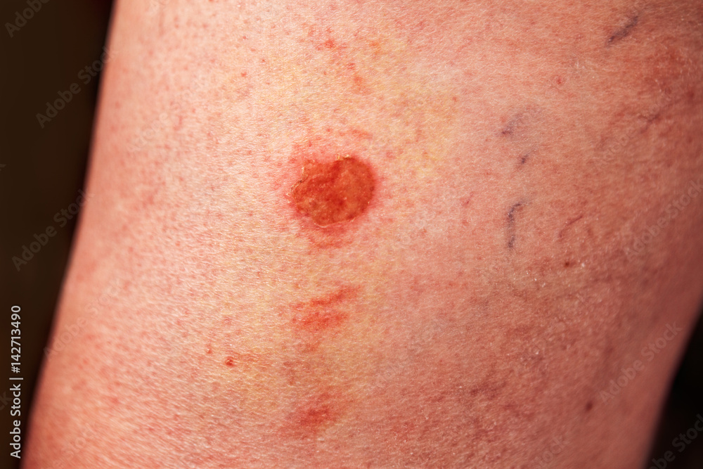 Fototapeta premium Horrible burns on female leg