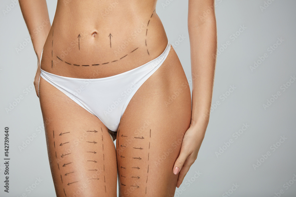 Surgical Lines. Woman Body In White Underwear With Marks On Skin - obrazy, fototapety, plakaty 
