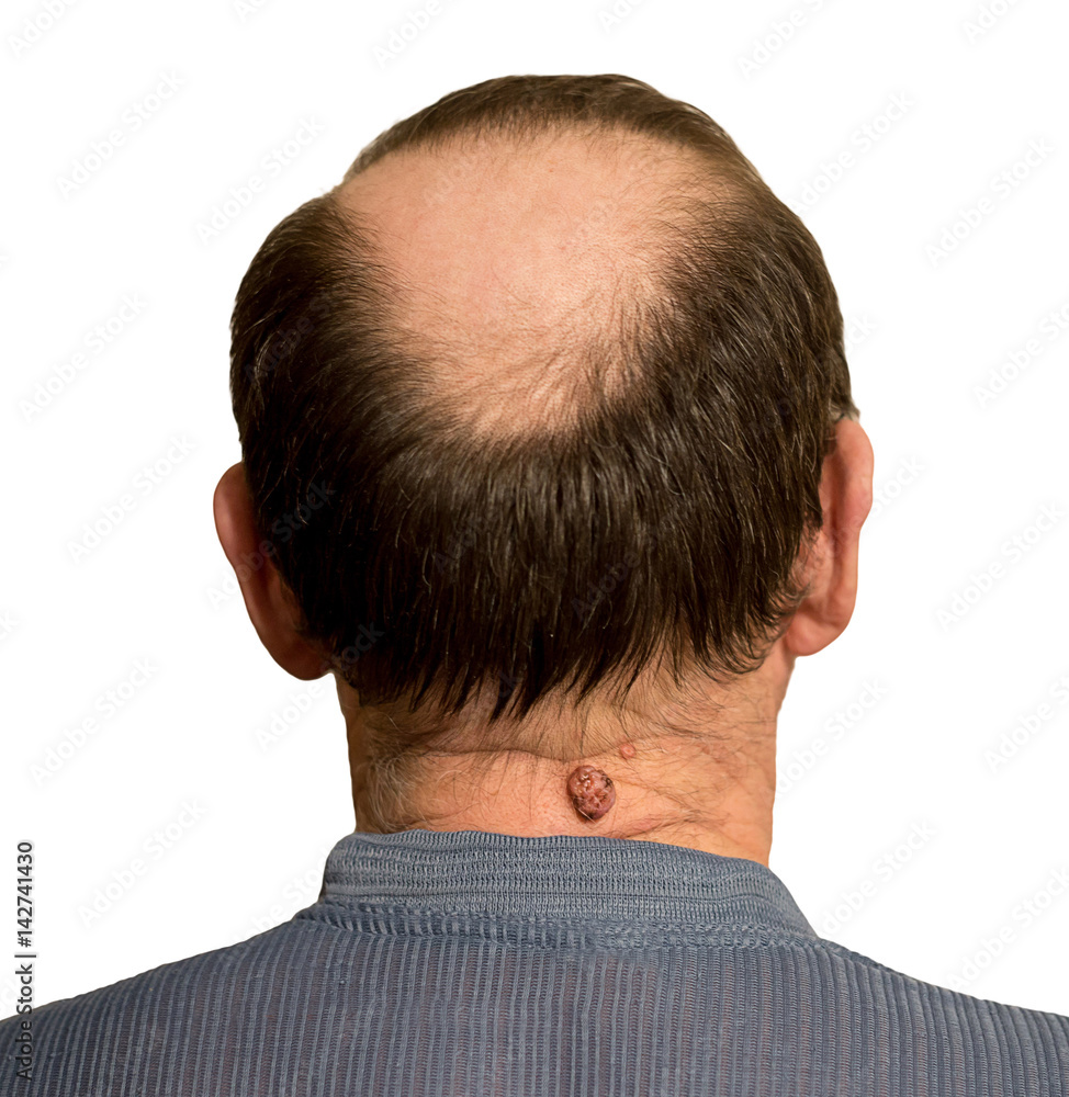 Fototapeta premium A man with alopecia and a mole on his neck