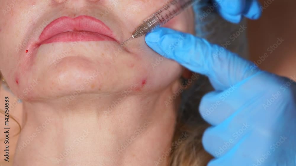 Close up shot of face of a middle-aged woman, where botulinum is injected by the doctor of privat clinic to smooth out facial wrinkles, as well as lip-chin wrinkles Close up shot of face of a middle-aged woman, where botulinum is injected by the doctor of privat clinic to smooth out facial wrinkles, as well as lip-chin wrinkles