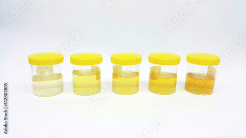 Картината върху платно Urine in plastic container