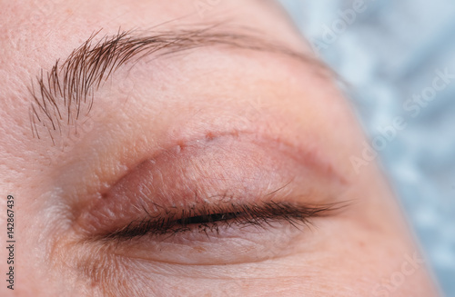 Blepharoplasty of the upper eyelid.