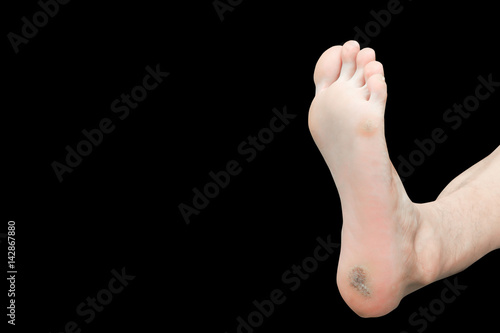 foot corn isolated on black background with clipping path