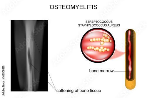bone lesions osteomyelitis photo