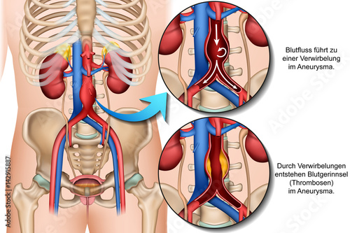 Entstehung eines Bauchaortenaneurysmas, Aneurysma vektor Illustration photo