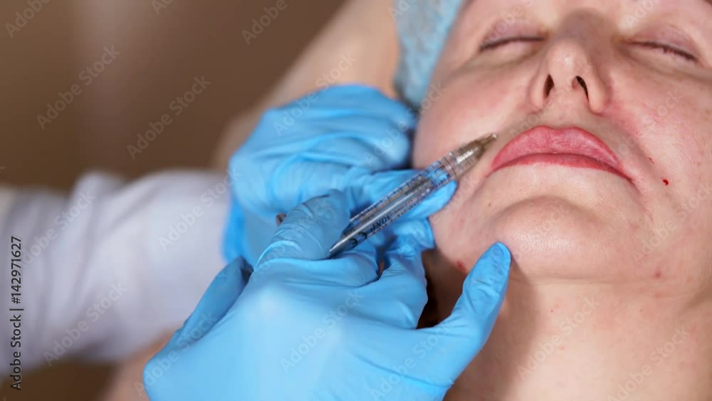 Close up shot of the process of introducing botulinum toxin into the nasolabial part of the face. The cosmetologist injects to immobilize the Botox muscles responsible for the appearance of wrinkles Close up shot of the process of introducing botulinum toxin into the nasolabial part of the face. The cosmetologist injects to immobilize the Botox muscles responsible for the appearance of wrinkles
