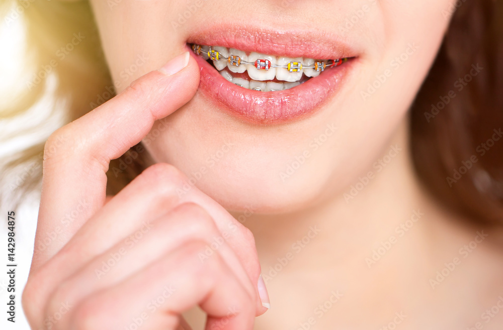 Beautiful girl with perfect skin and multi-colored braces posing on white backgraund Beautiful girl with perfect skin and multi-colored braces posing on white backgraund