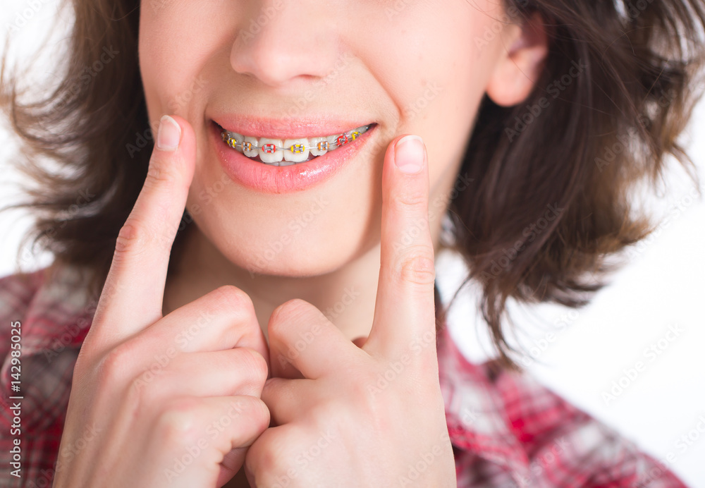 Beautiful girl with perfect skin and multi-colored braces posing on white backgraund Beautiful girl with perfect skin and multi-colored braces posing on white backgraund