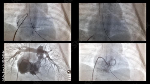Catheterization of the heart and vessels in the X-ray